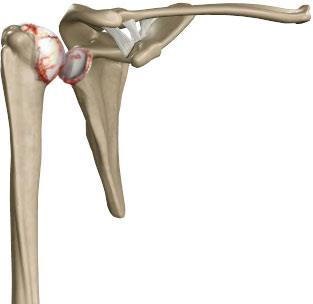 arthritis-of-the-shoulder