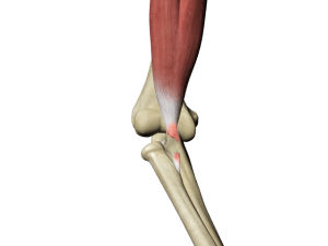 bicep-tendon-tear-at-elbow