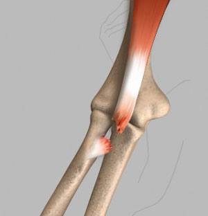 Post-traumatic Stiffness (Elbow)