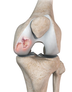 Chondral or Articular Cartilage Defects