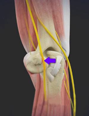 Cubital Tunnel Release (Medial Epicondylectomy)