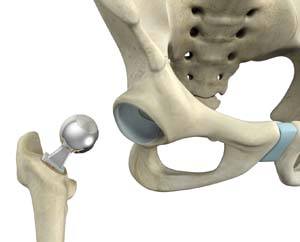 Hip Hemiarthroplasty