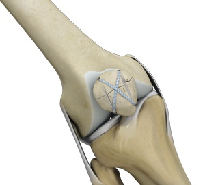 Patella shop knee surgery