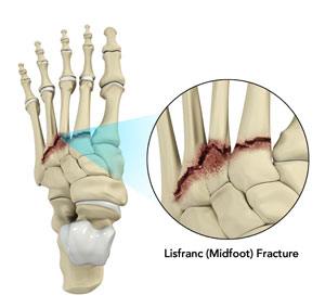 lisfranc-midfoot-injury