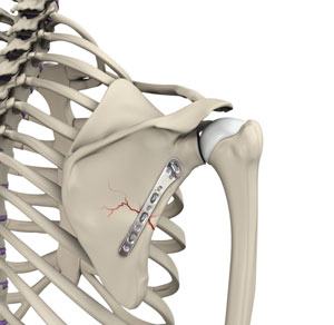 ORIF of the Scapula Fractures