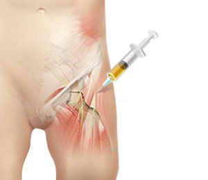 Platelet-Rich Plasma (PRP) Injection