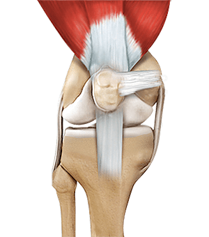 Quadriceps Tendon Repair