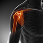 Rotator Cuff Calcification