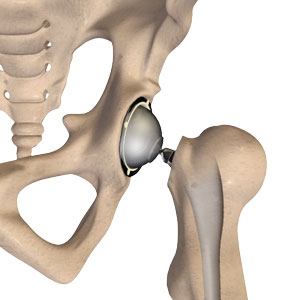 Total Hip Replacement Henderson  Hip Arthritis Treatment Summerlin