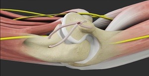 UCL Reconstruction (Tommy John Surgery)